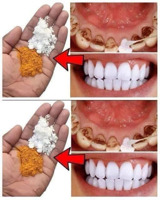 Teeth whitening in just 2 minutes – turning yellow and accumulated tartar into milk-like white and shiny