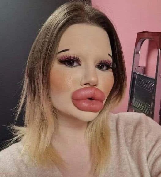 24-year-old woman wants the biggest lips in the world