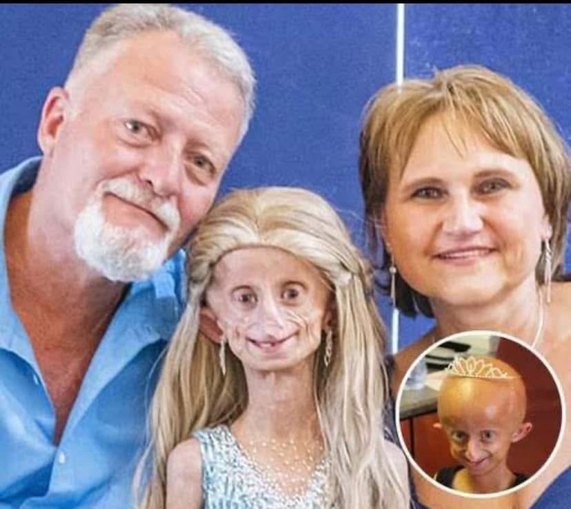 Beandri Booysen: Girl in South Africa with progeria dies