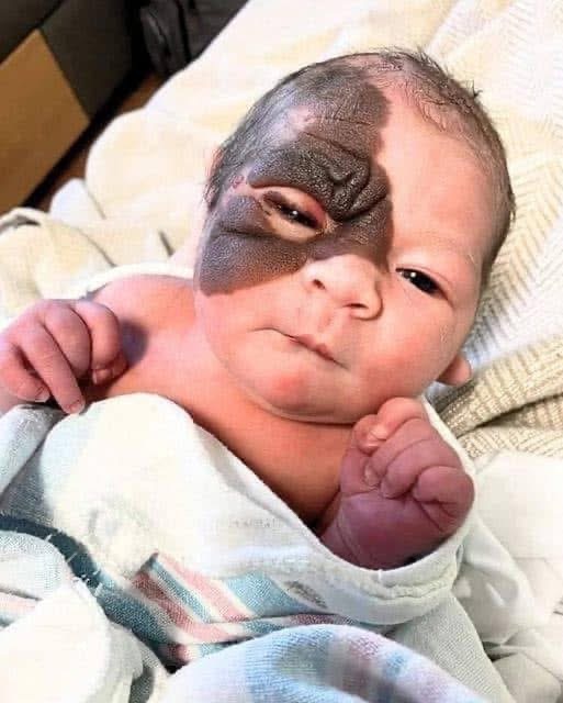 When Winry was born her ”Strange Birthmark” stunned people. Try not to smile when you see this brave girl today… Check the comments